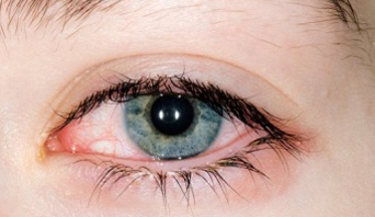 конъюктивит глаз лечение